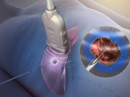 Ablation endoscopique