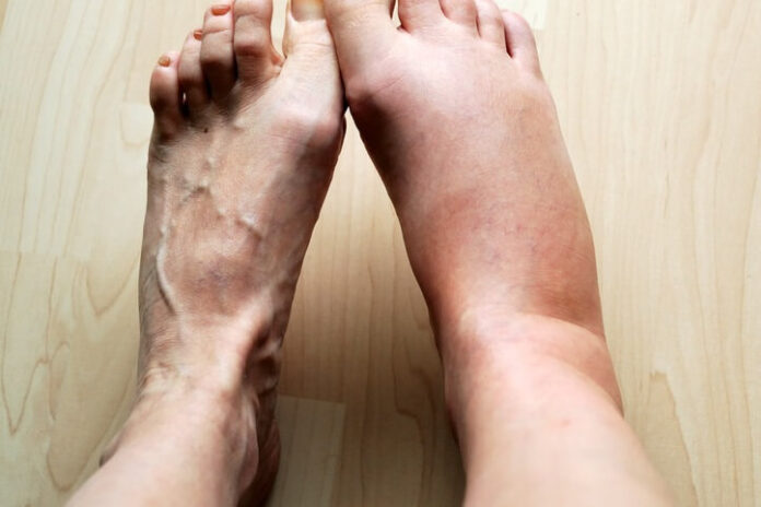 5 أطعمة تساعد على تقليل احتباس السوائل